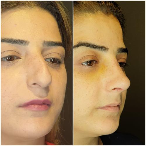 fotos antes y después de nuestros pacientes 9